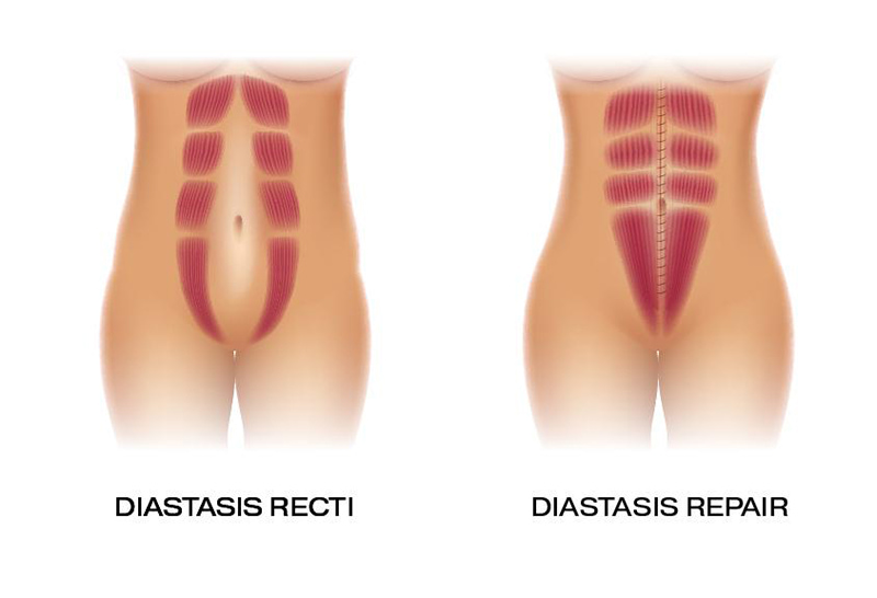 diastasis repair before and after